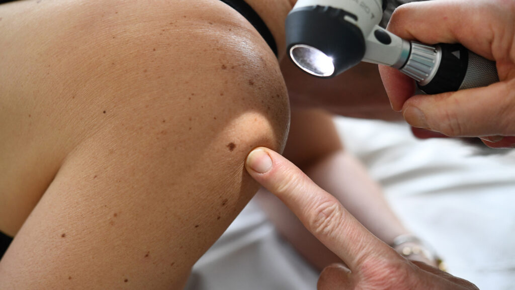 A new cancer vaccine may keep melanoma from coming back