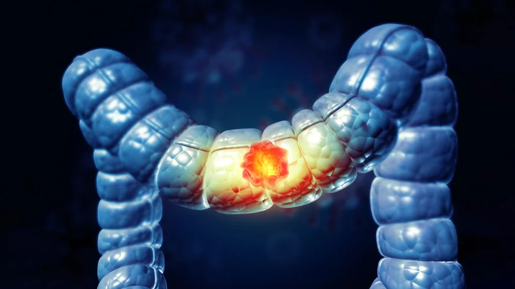 A simple at-home test could cut colorectal cancer death risk by 43%