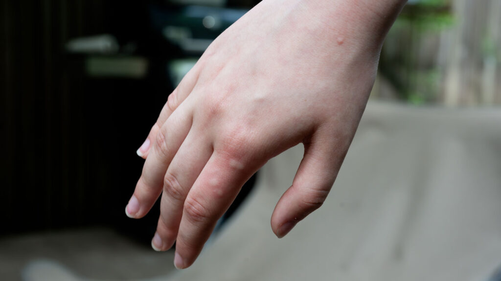Your skin chemistry may affect which mosquitoes most want to bite you