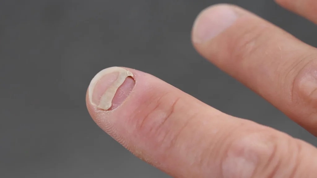 Popular weight loss drugs linked to a surprising fingernail problem