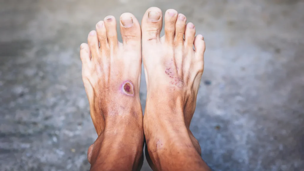 Scientists may have found why diabetic wounds refuse to heal